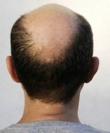 Découverte d'un gène impliqué dans la chute des cheveux