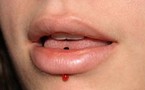 Les piercings de la bouche inquiètent les orthodontistes